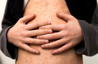 Kansas and Ohio Report Surge in Measles Cases Amid Outbreaks